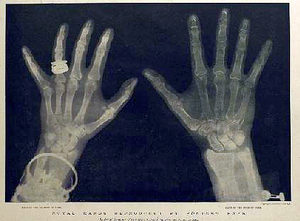 1896 xrays